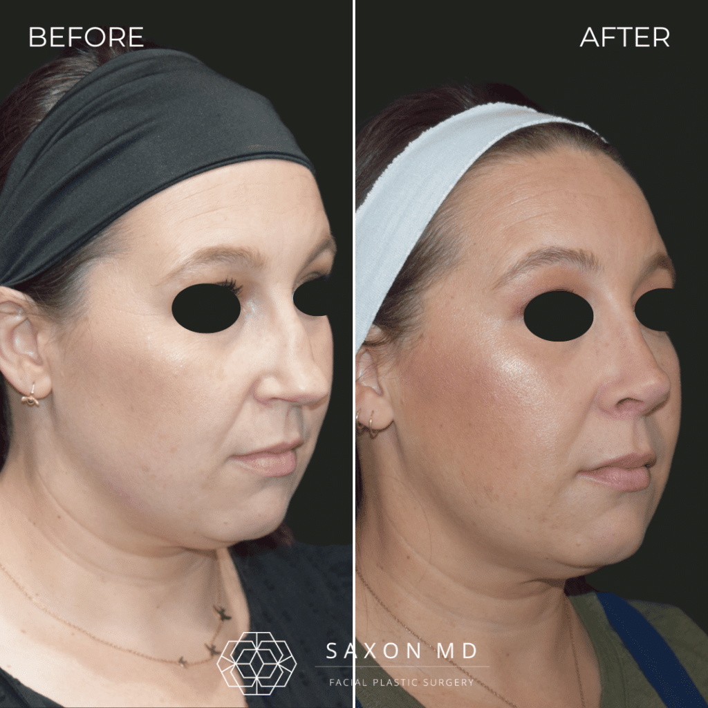 rhinoplasty before and after photos from Saxon MD in Austin and Dallas, TX; rhinoplasty austin