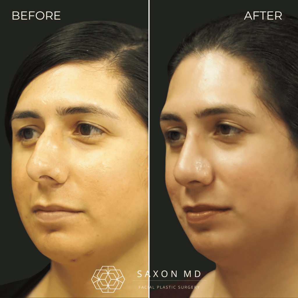 rhinoplasty before and after photos from Saxon MD in Austin and Dallas, TX; rhinoplasty austin