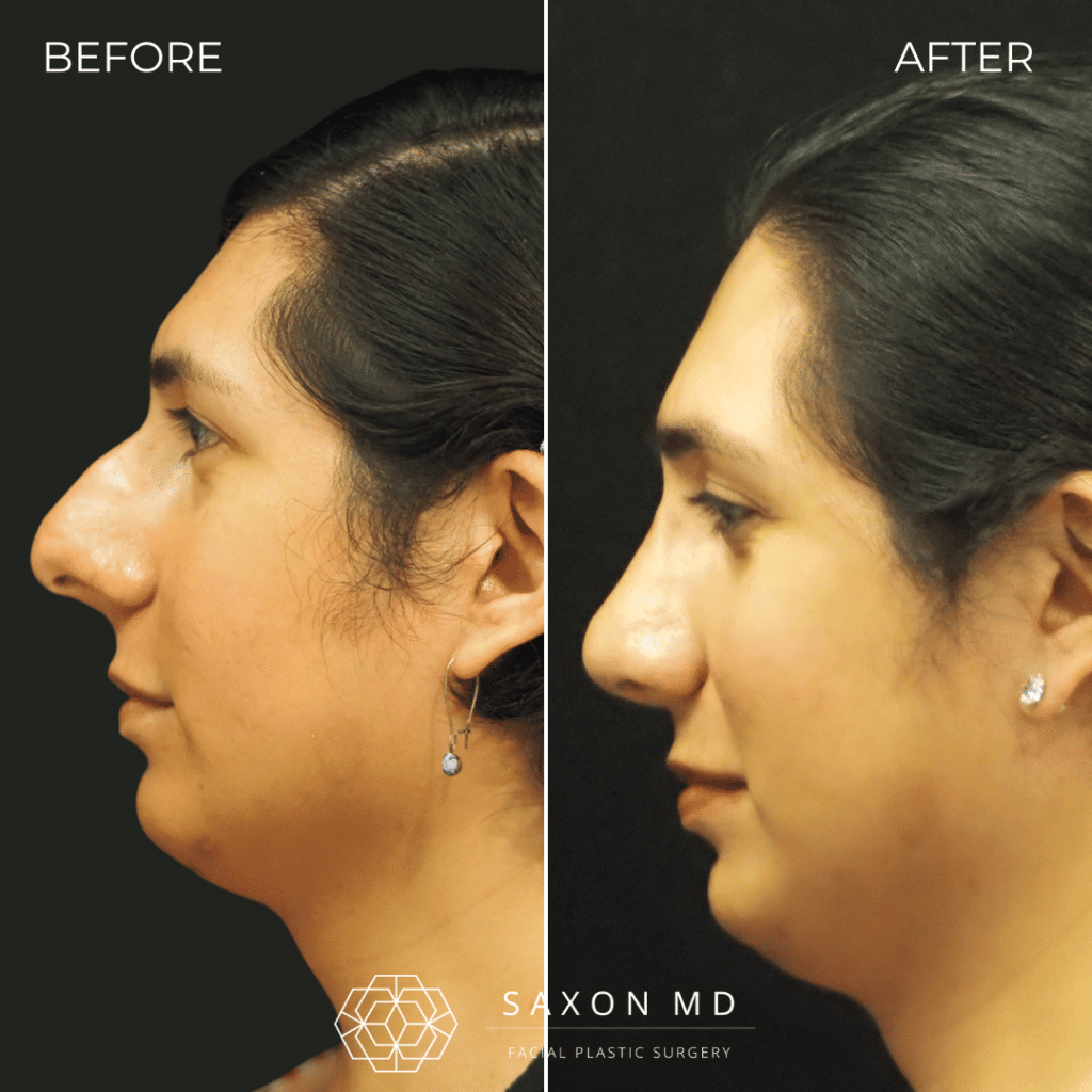 rhinoplasty before and after photos from Saxon MD in Austin and Dallas, TX; rhinoplasty austin