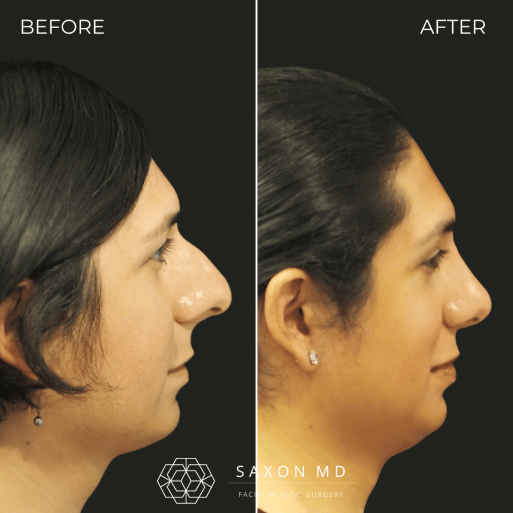 rhinoplasty before and after photos from Saxon MD in Austin and Dallas, TX; rhinoplasty austin