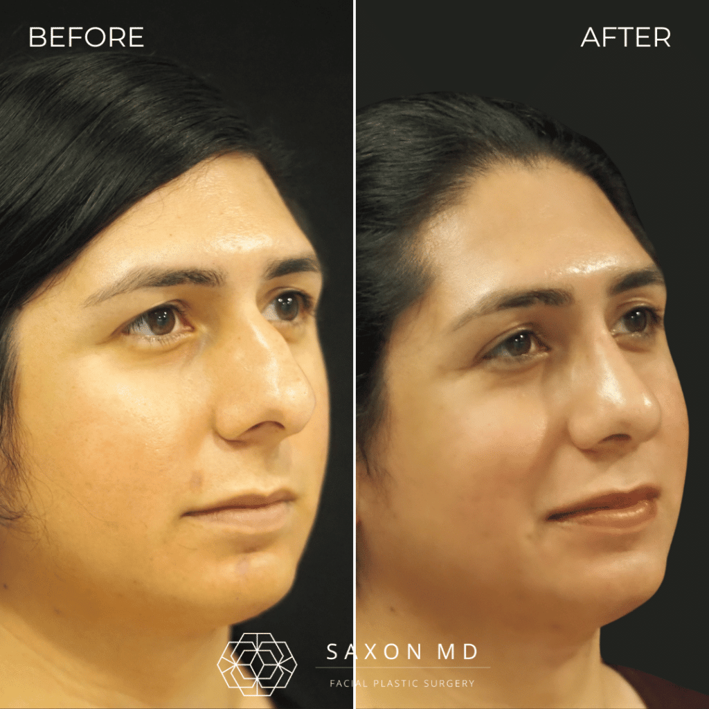 rhinoplasty before and after photos from Saxon MD in Austin and Dallas, TX; rhinoplasty austin