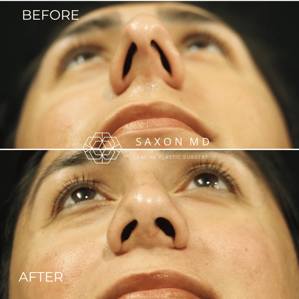 rhinoplasty before and after photos from Saxon MD in Austin and Dallas, TX; rhinoplasty austin