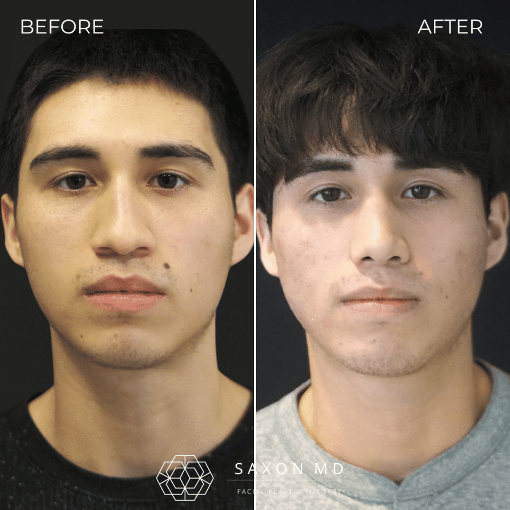 rhinoplasty before and after photos from Saxon MD in Austin and Dallas, TX; rhinoplasty austin