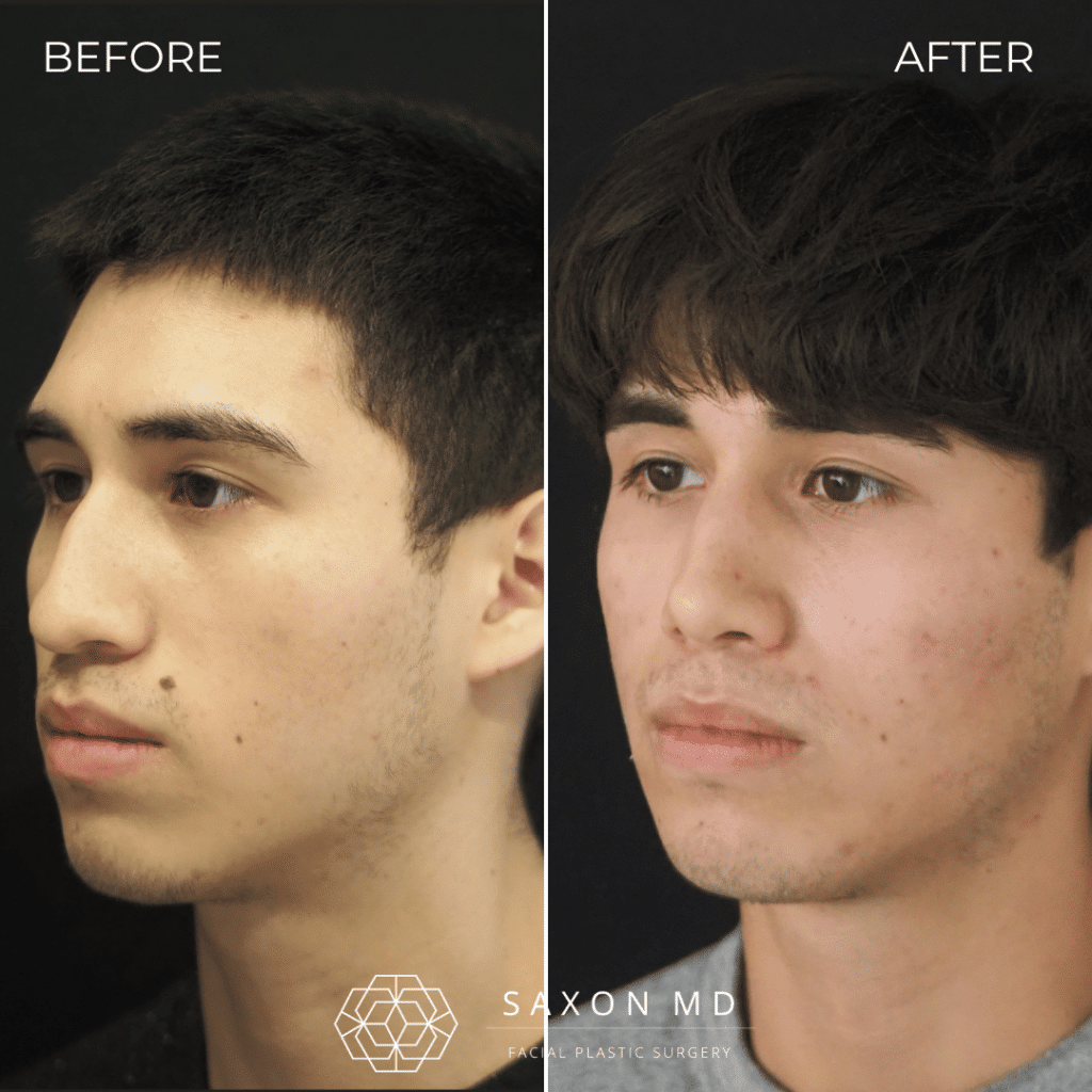 rhinoplasty before and after photos from Saxon MD in Austin and Dallas, TX; rhinoplasty austin