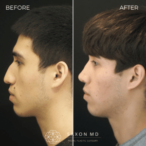 rhinoplasty before and after photos from Saxon MD in Austin and Dallas, TX; rhinoplasty austin; side profile