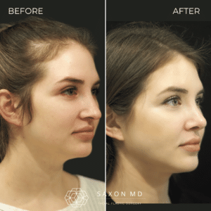 rhinoplasty before and after photos from Saxon MD in Austin and Dallas, TX; rhinoplasty austin; rhinoplasty complications