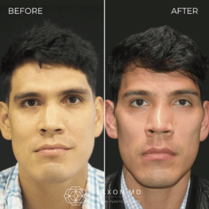 brow bone reduction before and after, brow ridge male, Saxon MD Austin and Dallas, TX