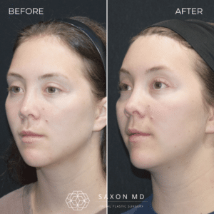 brow bone reduction before and after photo and Saxon MD in Austin and Dallas, TX; forehead contouring