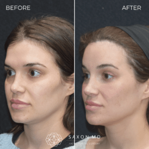 brow bone reduction before and after photo at Saxon MD in Austin and Dallas, TX; facial feminization surgery on female; FFS