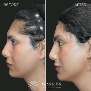 brow bone reduction before and after photo and Saxon MD in Austin and Dallas, TX