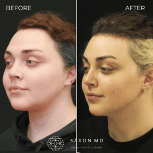 brow bone reduction before and after photo and Saxon MD in Austin and Dallas, TX; brow bone reduction complications; big forehead
