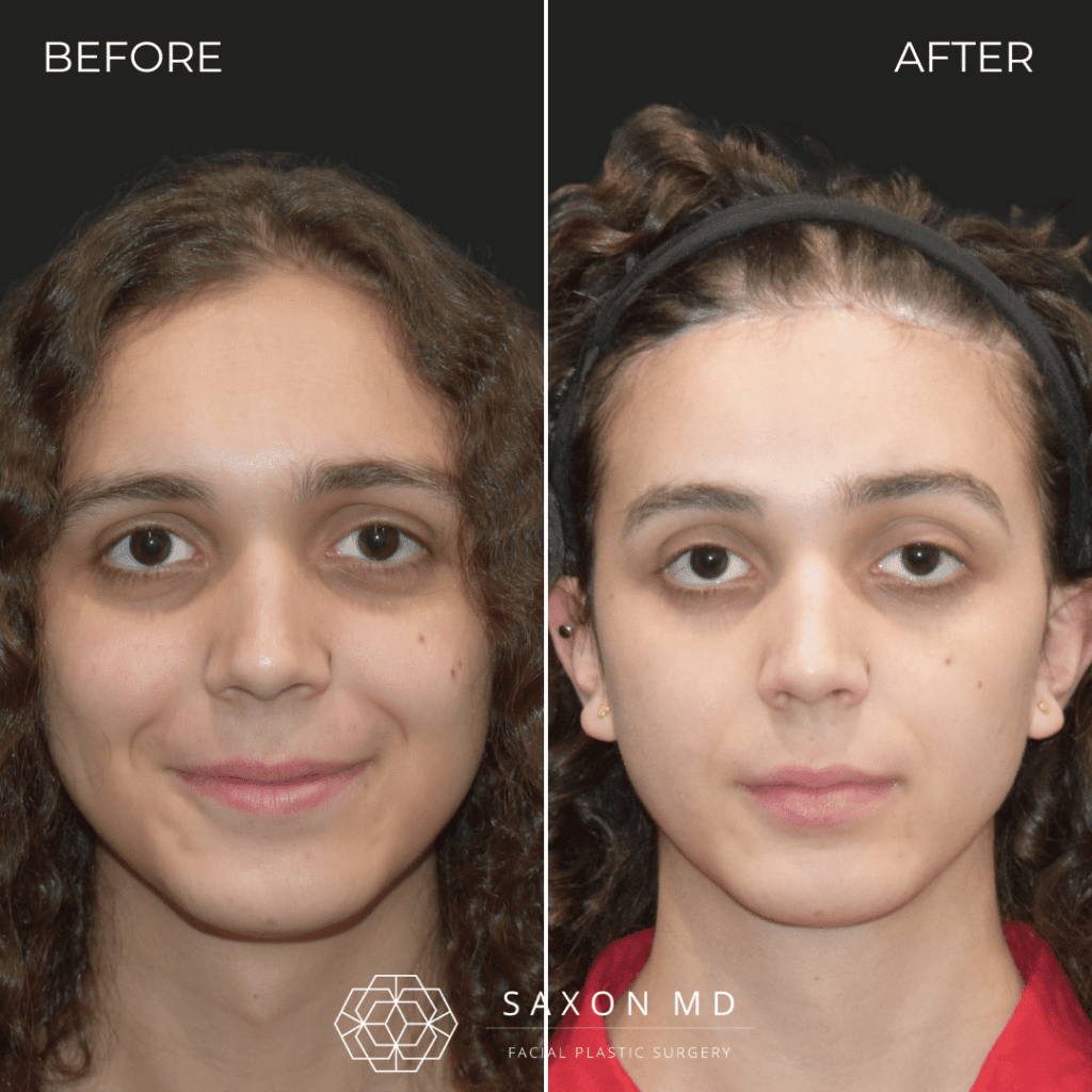 brow bone reduction before and after photo and Saxon MD in Austin and Dallas, TX