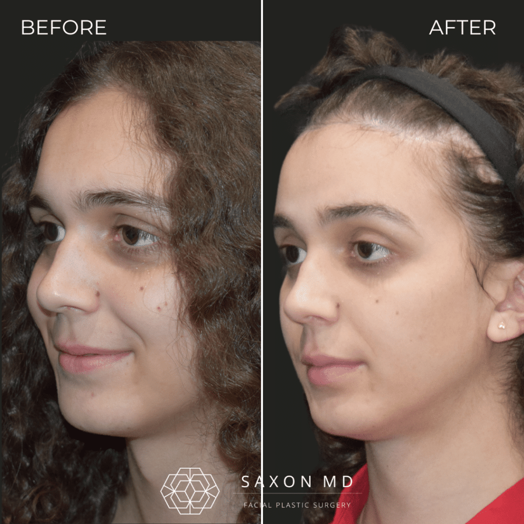 brow bone reduction before and after photo and Saxon MD in Austin and Dallas, TX