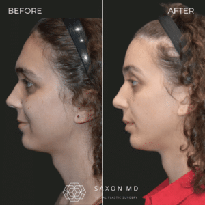 brow bone reduction before and after photo and Saxon MD in Austin and Dallas, TX