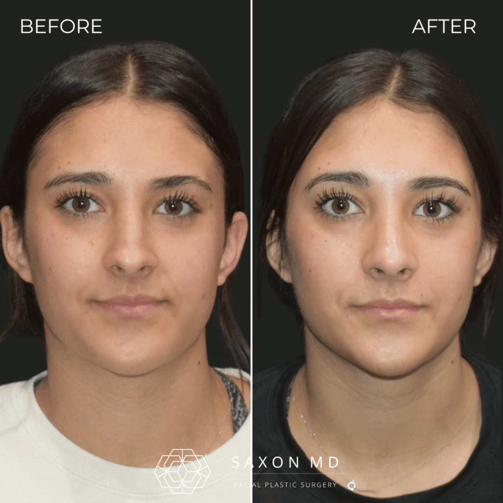 rhinoplasty before and after photo from Saxon MD in Austin and Dallas, TX; rhinoplasty Austin