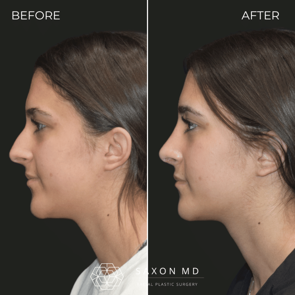 rhinoplasty before and after photo from Saxon MD in Austin and Dallas, TX; rhinoplasty Austin