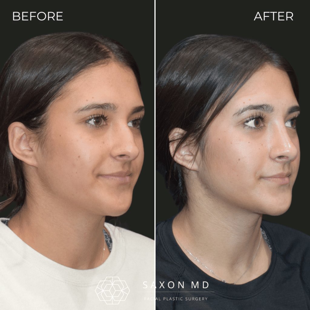 rhinoplasty before and after photo from Saxon MD in Austin and Dallas, TX; rhinoplasty Austin