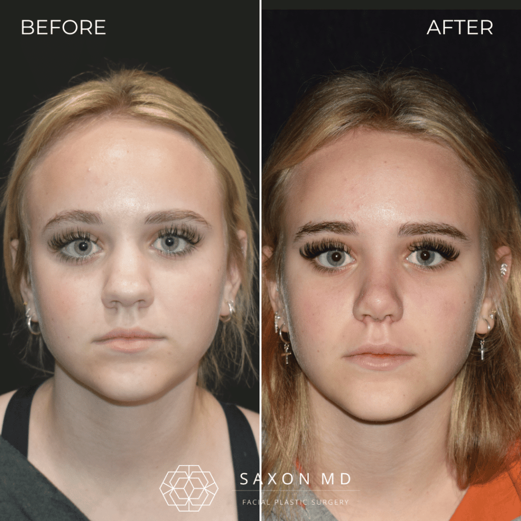 rhinoplasty before and after photo from Saxon MD in Austin and Dallas, TX; rhinoplasty Austin