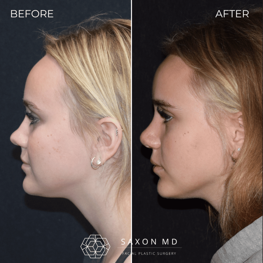 rhinoplasty before and after photo from Saxon MD in Austin and Dallas, TX; rhinoplasty Austin