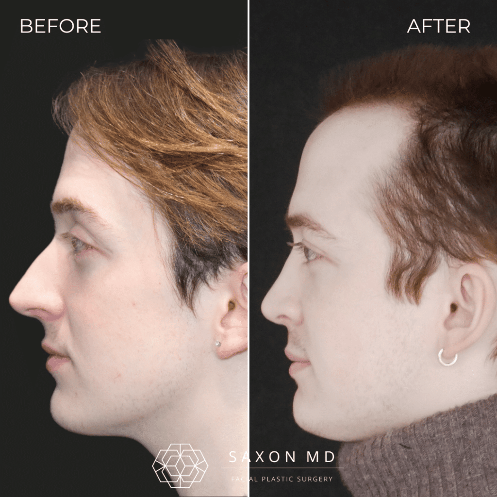 rhinoplasty before and after photo from Saxon MD in Austin and Dallas, TX; rhinoplasty Austin