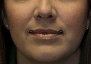 corner lip lift to explain the different types of lip lifts