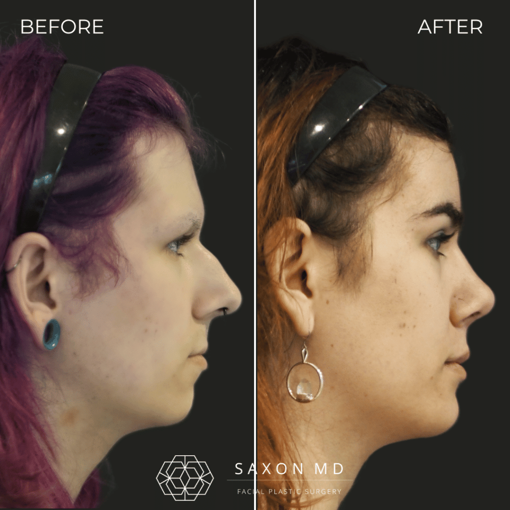 facial feminization surgery before and after photo from a patient at Saxon MD in Austin and Dallas, TX; ffs before and after