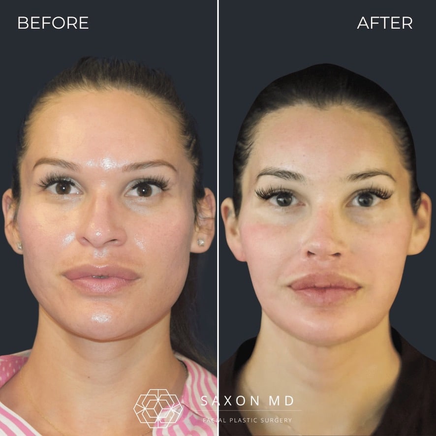 facial feminization surgery before and after photo from a patient at Saxon MD in Austin and Dallas, TX; ffs before and after