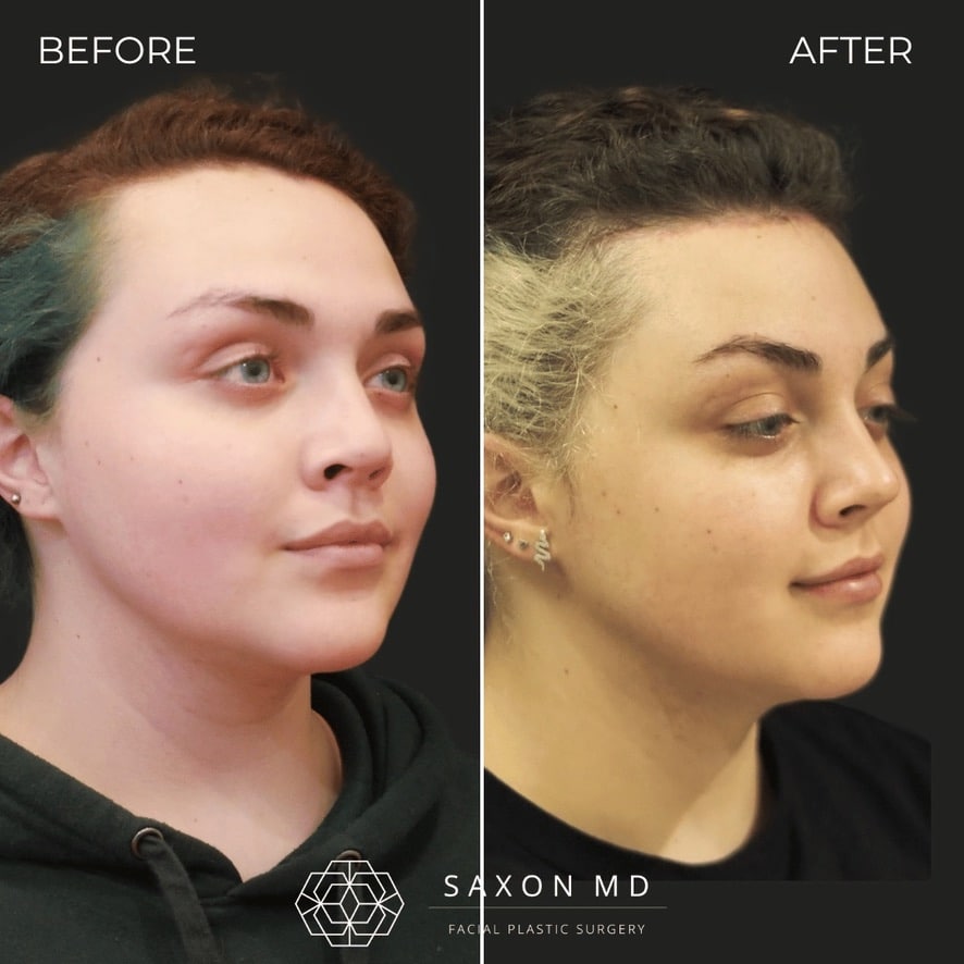 facial feminization surgery before and after photo from a patient at Saxon MD in Austin and Dallas, TX; ffs before and after