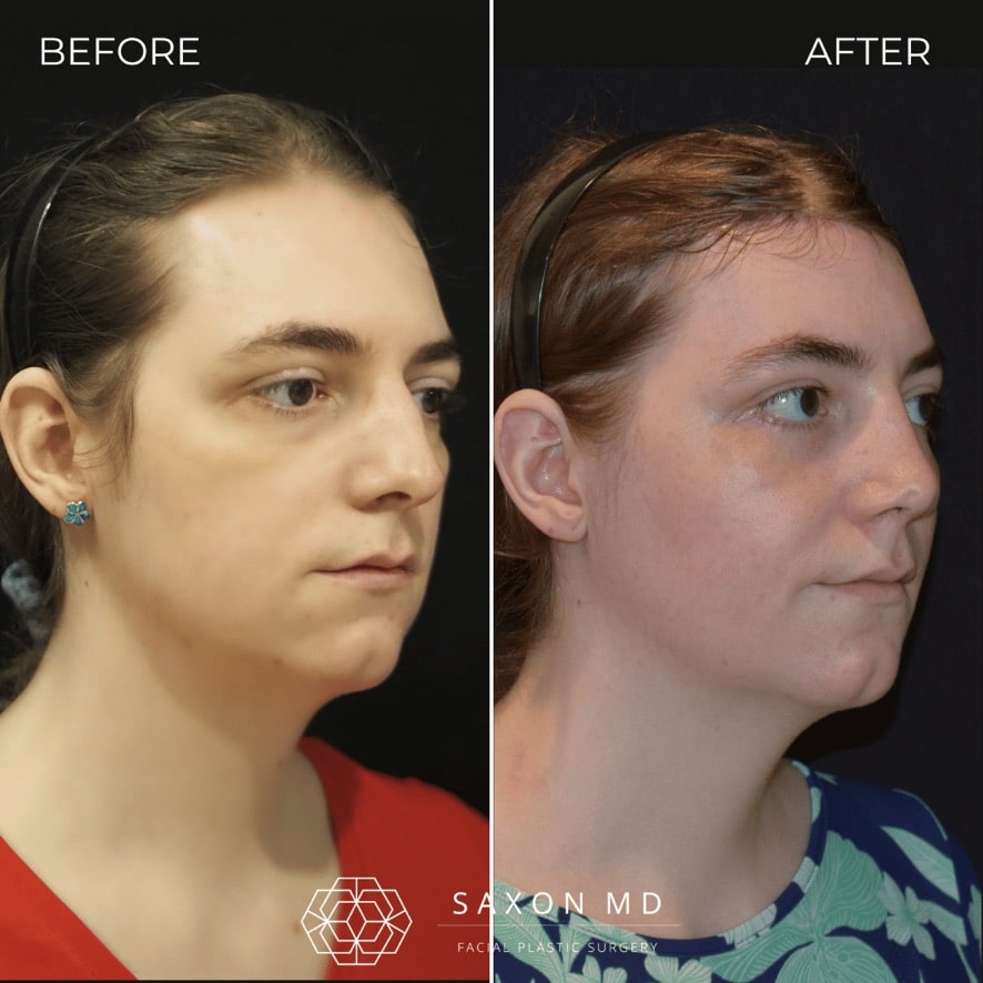 facial feminization surgery before and after photo from a patient at Saxon MD in Austin and Dallas, TX; ffs before and after