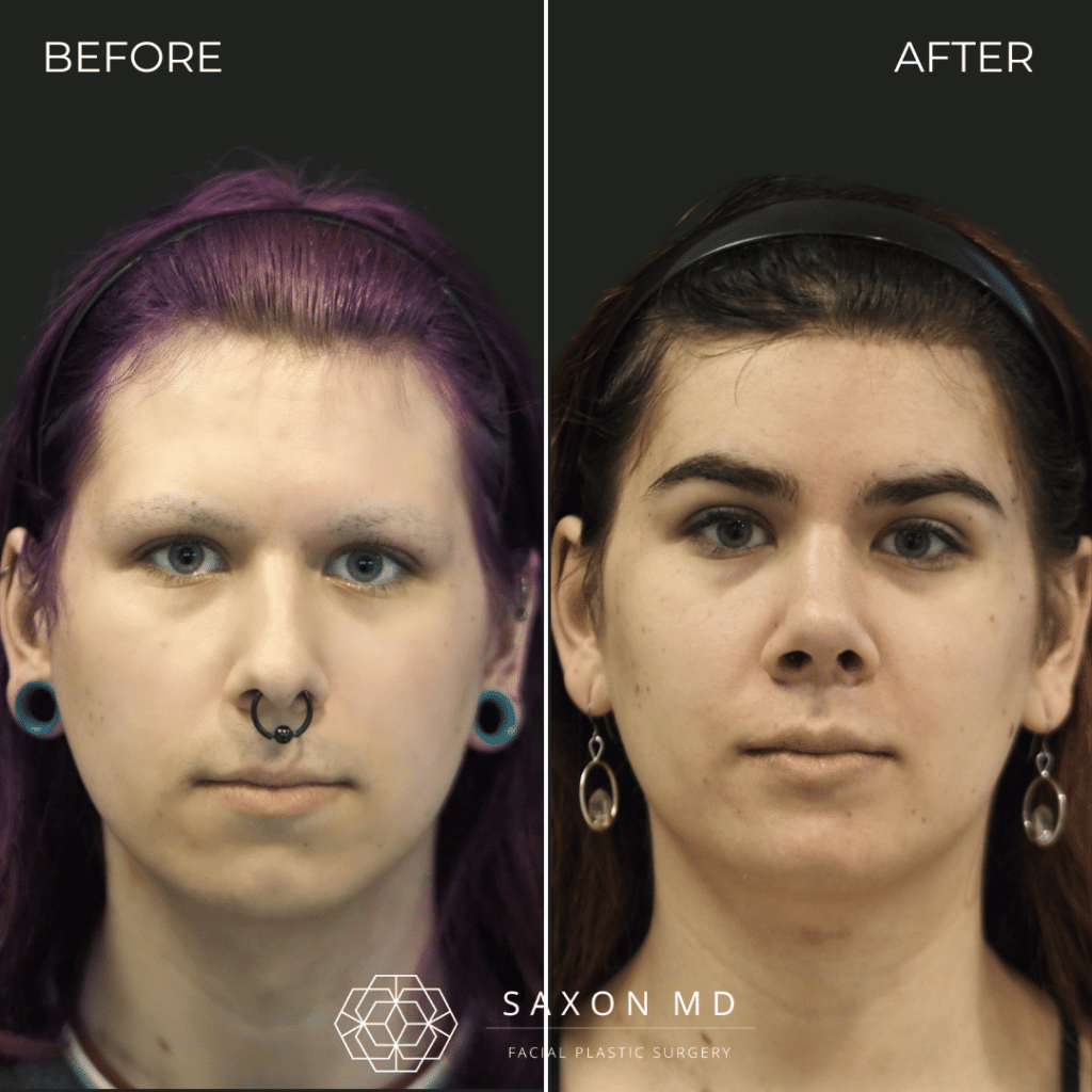 facial feminization surgery before and after photo from a patient at Saxon MD in Austin and Dallas, TX; ffs before and after