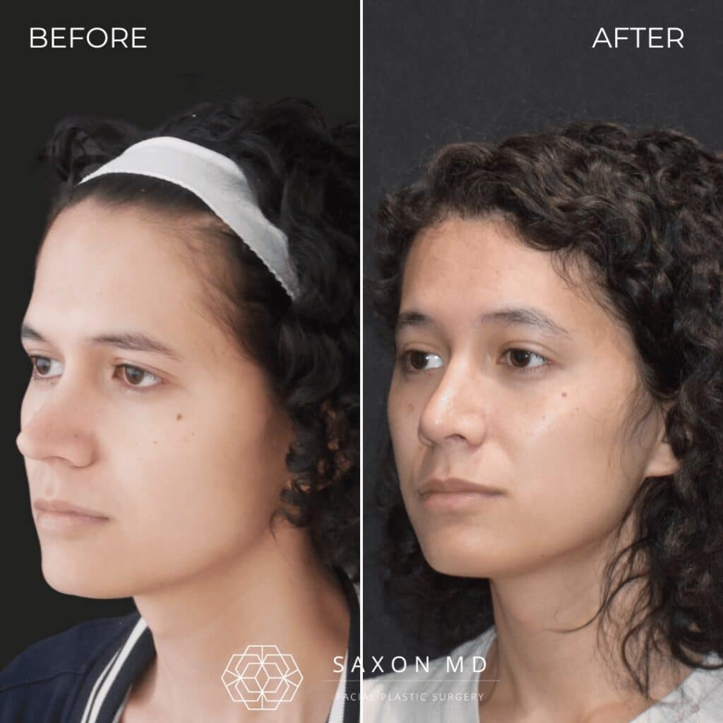 facial feminization surgery before and after photo from a patient at Saxon MD in Austin and Dallas, TX; ffs before and after; rhinoplasty before and after