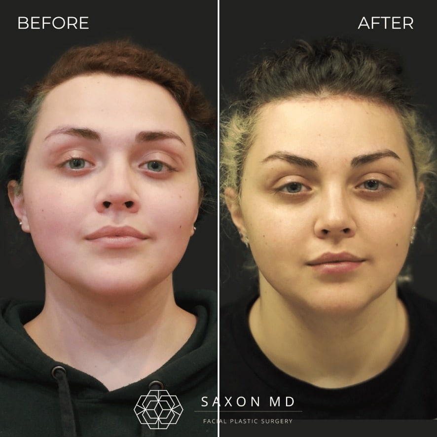 facial feminization surgery before and after photo from a patient at Saxon MD in Austin and Dallas, TX; ffs before and after