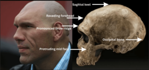 Man with a prominent brow ridge and comparison to a Neanderthal brow