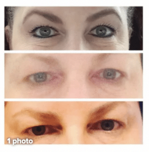 photo showing a brow droop from dysport to show how nonsurgical treatments that make you look masculine