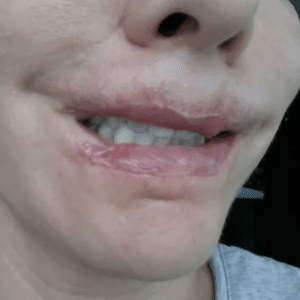 botched lip lift after a direct lip lift