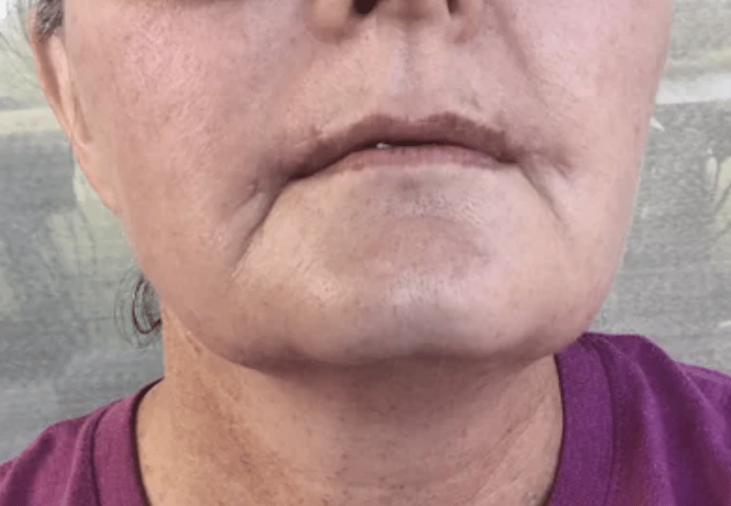 Botched Lip Lift: What Can Go Wrong And How To Avoid It