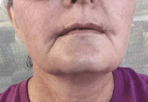 botched lip lift