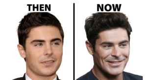 zac efron, buccal fat removal in men