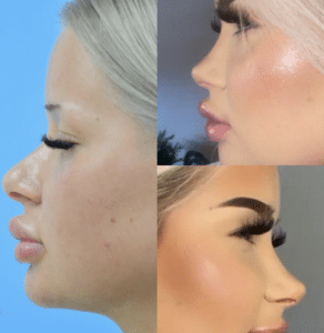 barbie nose