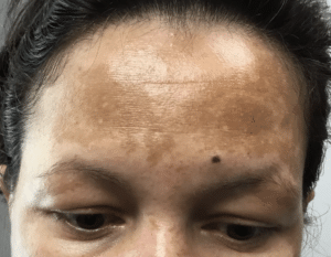 best treatment for melasma