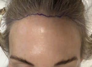 brow lift scars: pretricheal brow lift