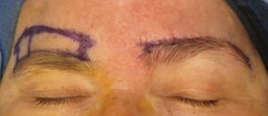 brow lift scars: direct brow lift