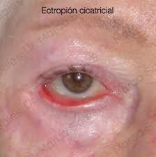 blepharoplasty complications - ectropion