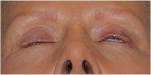 blepharoplasty complications - lagophthalmos