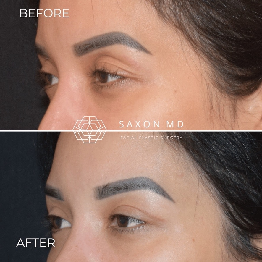 blepharoplasty before and after; Saxon MD in Austin and Dallas, TX