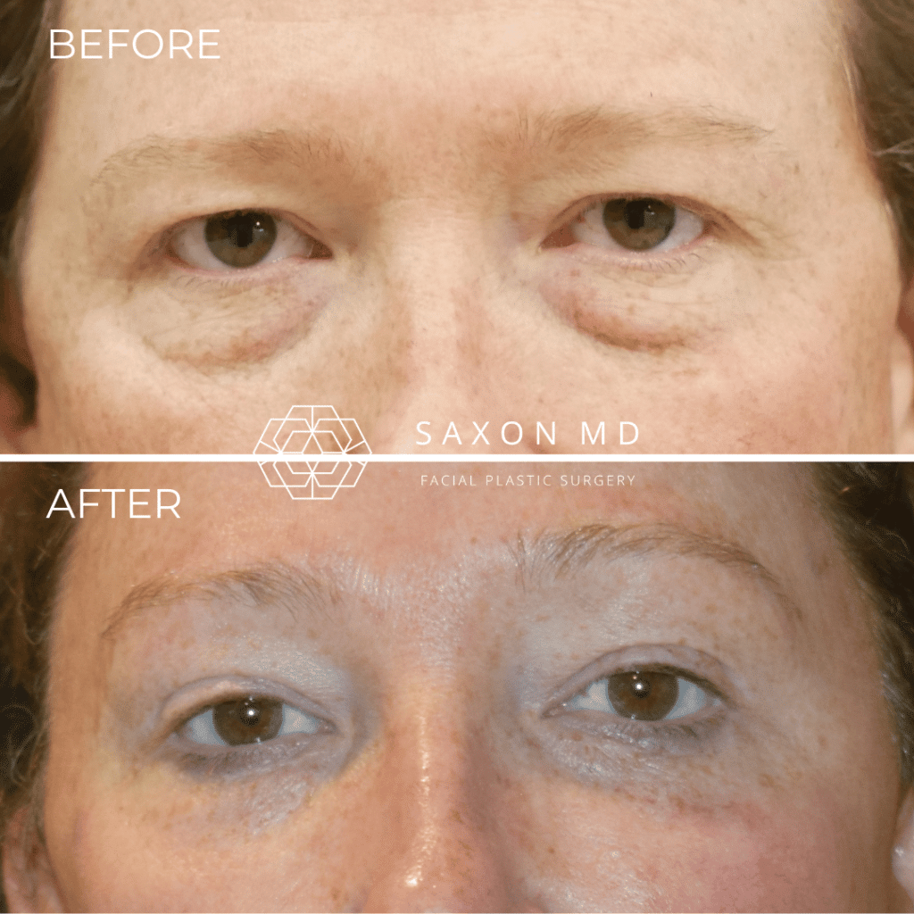 blepharoplasty before and after; Saxon MD in Austin and Dallas, TX