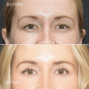 The Real Reason You Have Hooded Eyes (And What You Can Do About It) 3 blepharoplasty before and after; hooded eyes