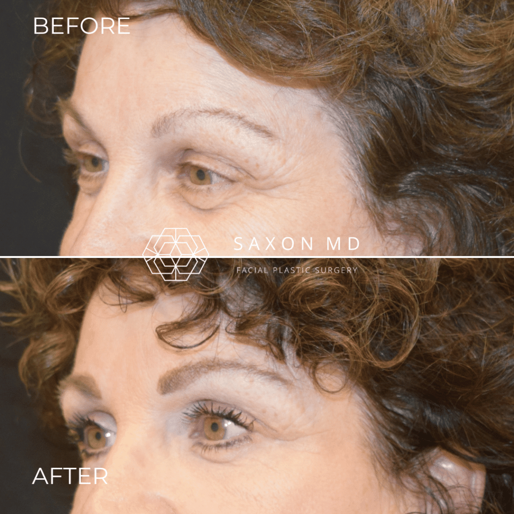 blepharoplasty before and after; Saxon MD in Austin and Dallas, TX