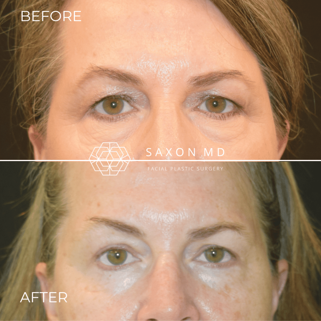 blepharoplasty before and after; Saxon MD in Austin and Dallas, TX