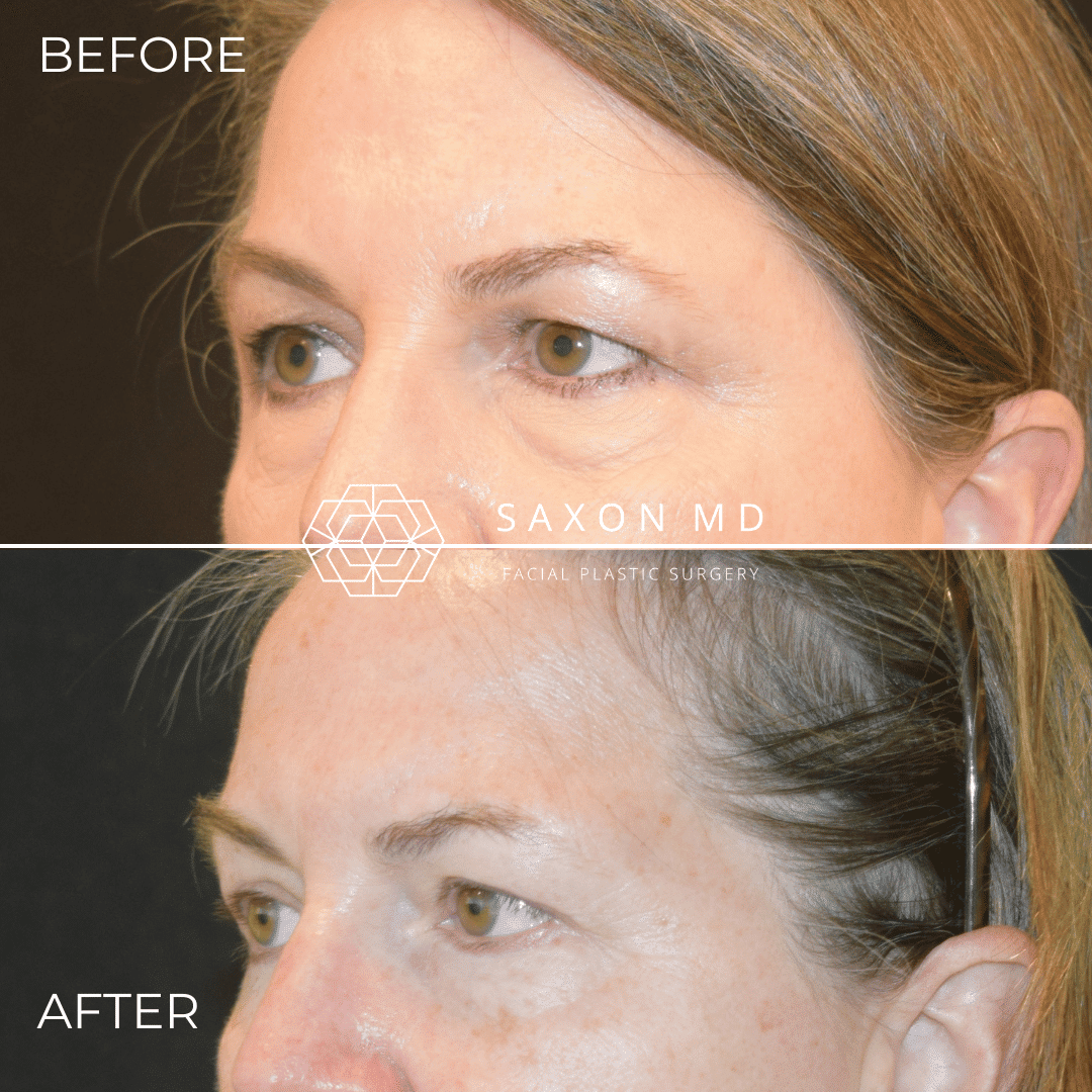 Blepharoplasty Before and After Pictures Case 558 | Scottsdale ... Blepharoplasty Before and After Pictures Case 558 | Scottsdale ...